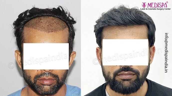 Dr. Suneet Soni - 3029 FUE Grafts, FUE Method (Trivellini System), NW - III photo