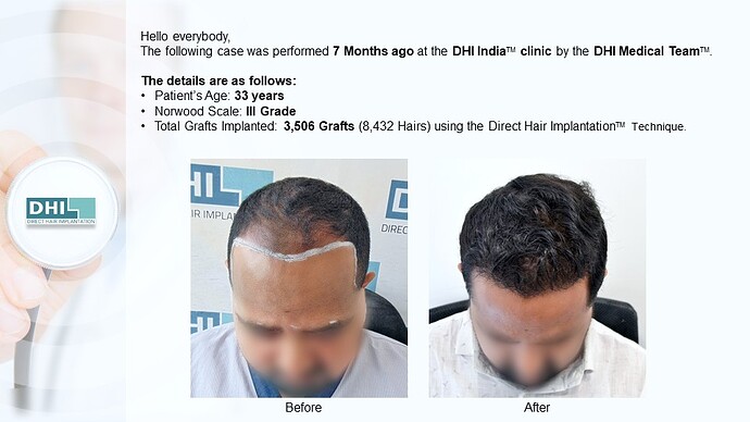 DHI India™ | NW 3 | 3,506 Grafts | 7 Months Hair Transplant photo