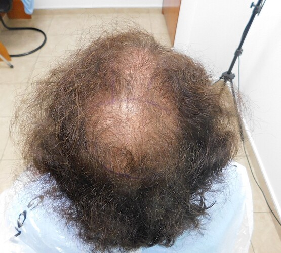 Hair Transplant Outcome with 4000 Grafts Across NW5 Zone – HDC Hair Clinic photo