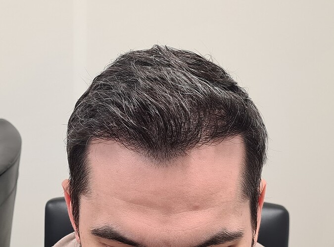 FUE Result for 4400 Grafts – 6 Months after – HDC Hair Clinic photo