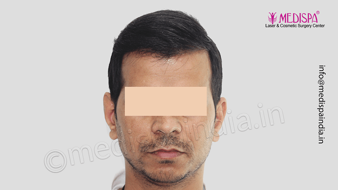 Dr. Suneet Soni - 4533 Grafts, Combine FUT + FUE Technique , NW-IV/V photo