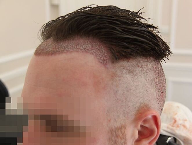 Dr.Bisanga, BHR Clinic, 1675 FUE, 0 - 13 Months photo