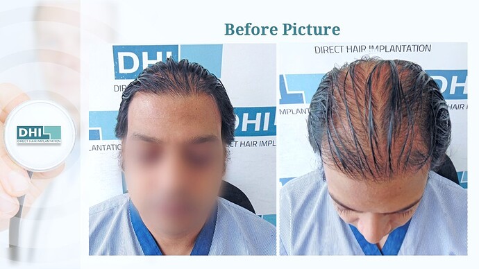 DHI India™ | 4,133 Grafts | Diffuse Alopecia | Full Coverage in 6 Months photo