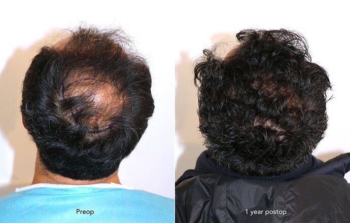 Case performed by Dr. Feriduni – 4485 FU in 1 day procedure photo