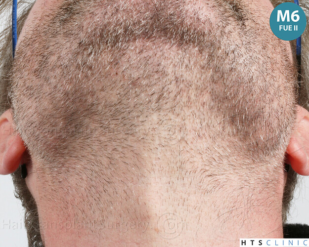 Dr. Jean Devroye, HTS Clinic / 6494 FUE-BHT (3150 + 3344) / NW VII, 2 sessions photo