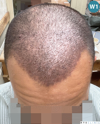 Dr Devroye + Dr Montesanti + Dr Jenard, HTS Clinic / 2018 FUE / Hairline & frontal area photo