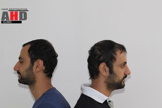 Identical Twin Hair Transplant Brother to Brother photo