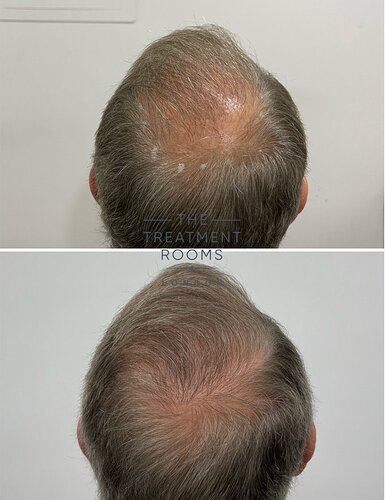 Crown Transplant - 2024 Grafts photo