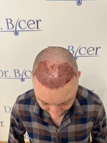 Ozlem Bicer MD-Hair Transplant-2910 Grafts FUE by micro-motor, 7. months result photo