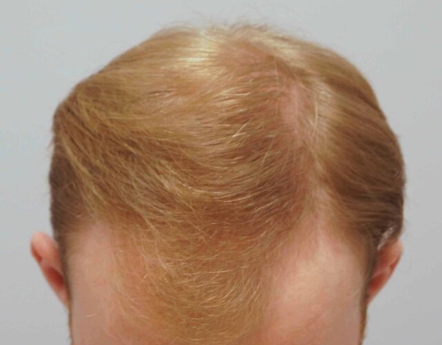 Dr B Farjo 1820 FUE (Fontal) Very early growth. photo