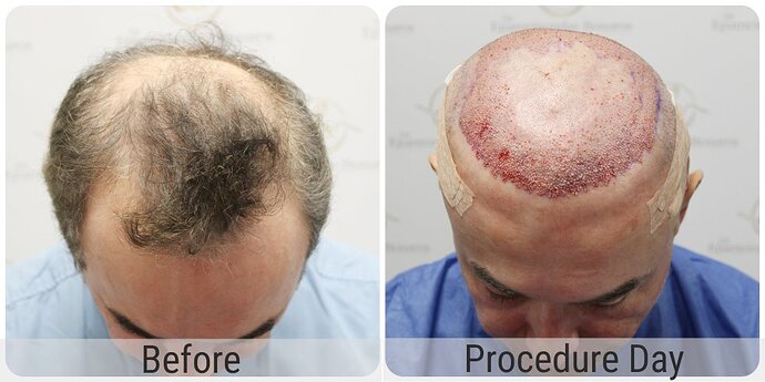 Dr Bonaros, Glasgow, UK / 3986 FUE grafts / 0-12 Months photo