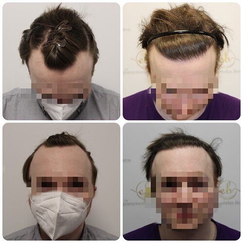 Dr Bonaros, Glasgow, UK / 1614 FUE grafts for receding Hairline / 0-12 Months photo