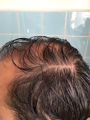 DR HAKAN DOGANAY/4055 GRAFTS/FUE+Implanter Pen photo