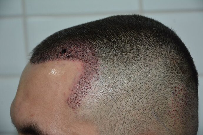 Hair Transplantation by Dr. Doganay / 1.400 grafts / Pen Implanter / 1 Year Result photo