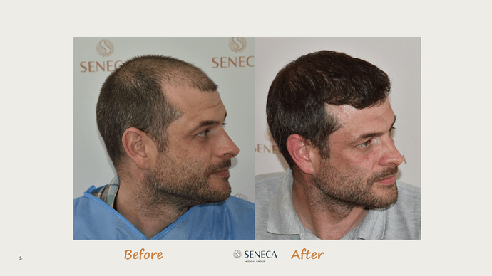 Seneca Medical Group - 2308 grafts with Direct Fue photo