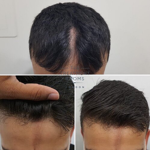 Hair Transplant Surgery for Linear Scleroderma 817 grafts photo