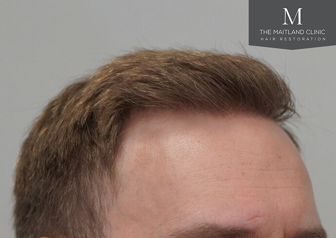 1826 grafts by FUE with Dr Edward Maitland Ball at The Maitland Clinic photo