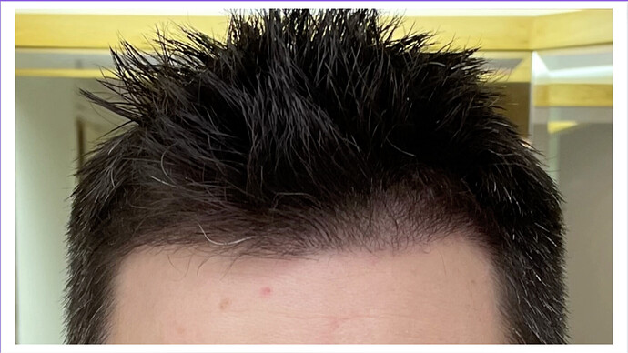 Dr. Bisanga + Dr. Kostis - BHR Clinic - 2176 FUE - 0 - 5 Months photo