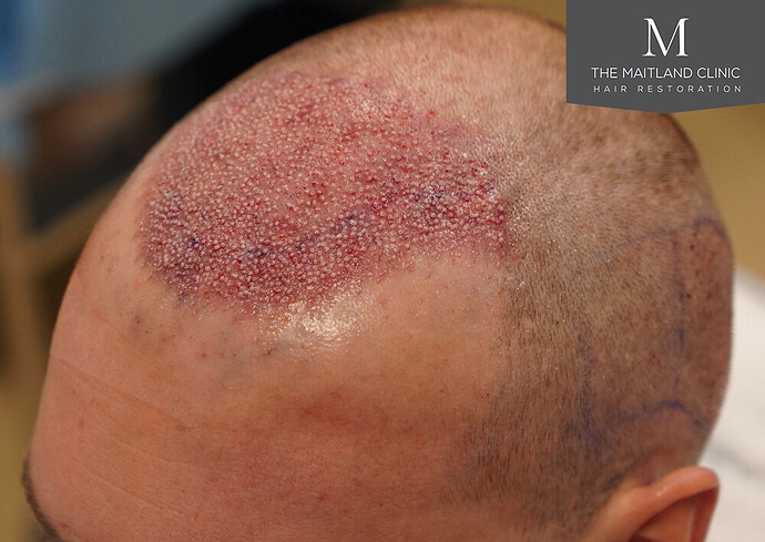 1826 grafts by FUE with Dr Edward Maitland Ball at The Maitland Clinic photo