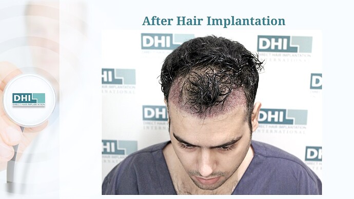 DHI India™ | NW 3 | 1,504 Grafts | 5 Months DHI Hair Transplant Results photo