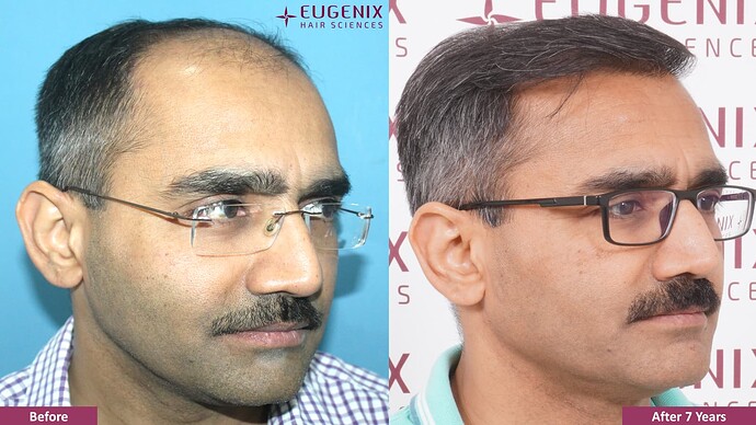 hair-transplant-before-after-5