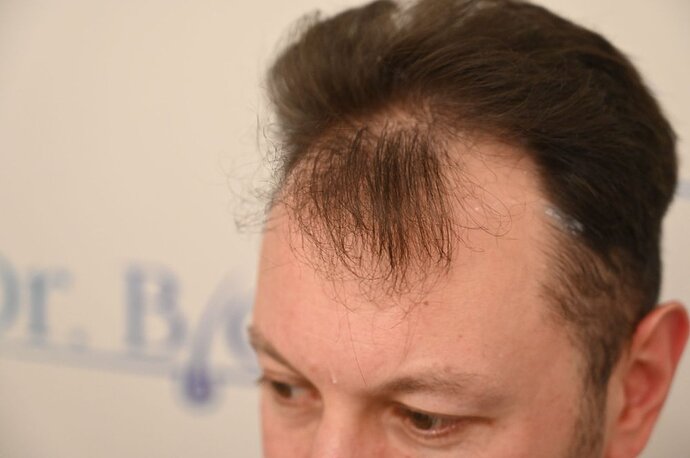 Ozlem Bicer MD-Hair Transplant-2910 Grafts FUE by micro-motor, 7. months result photo