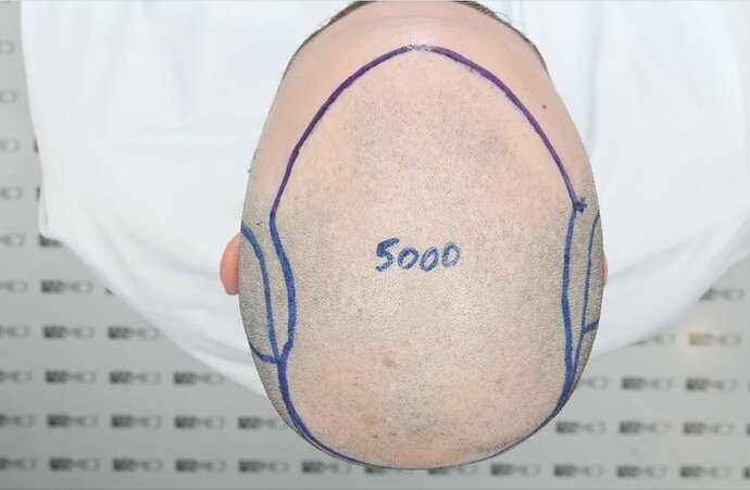 ASMED CLINIC CASE - DR.KORAY 5000 GRAFTS FUE photo