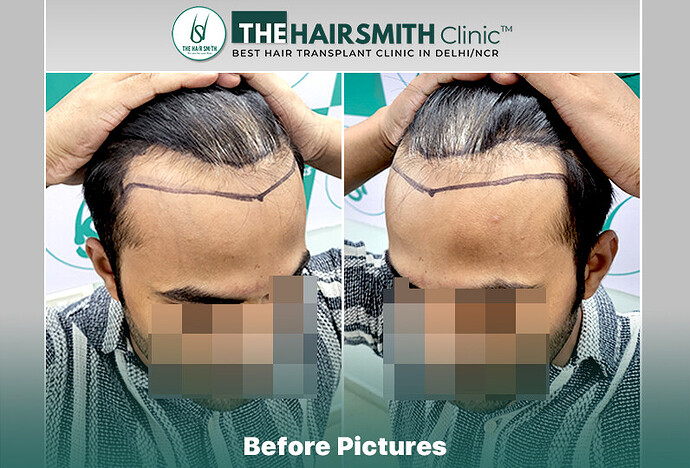 The HairSmith Clinic™ | NW Stage 3 | 2145 Grafts | 8 Months Hair Transplant Result photo