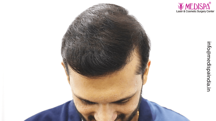 Dr. Suneet Soni - 4665 Grafts, Combine FUT + FUE + BHT (Beard) Technique photo