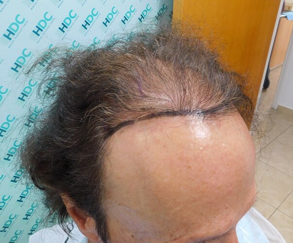 Hair Transplant Outcome with 4000 Grafts Across NW5 Zone – HDC Hair Clinic photo