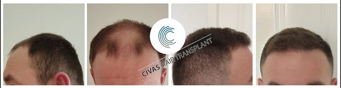 Civas Hair Transplant-- 3200 grafts-- fue-- after 1 year photo