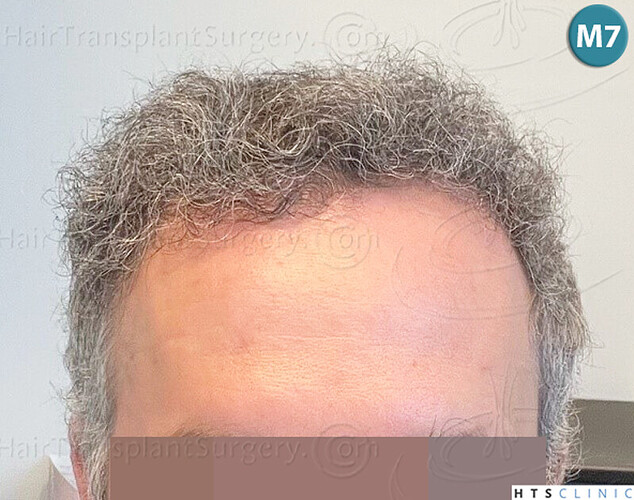 Dr Devroye + Dr Montesanti + Dr Jenard, HTS Clinic / 2932 FUE / Hairline & frontal area photo