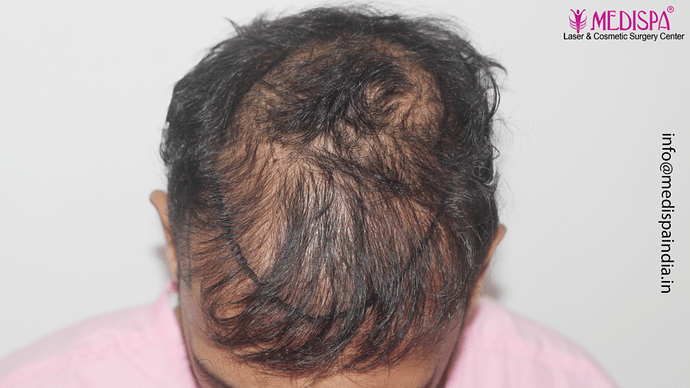 Dr. Suneet Soni - 4665 Grafts, Combine FUT + FUE + BHT (Beard) Technique photo