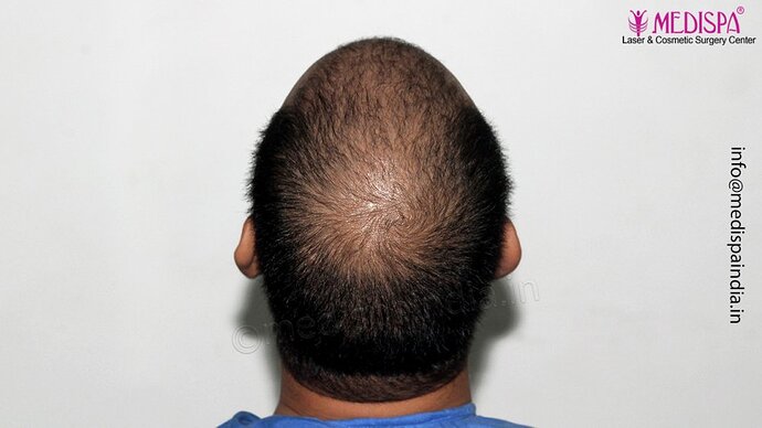 Dr. Suneet Soni - 4500 Grafts, Combine FUT + FUE Technique, NW-III photo