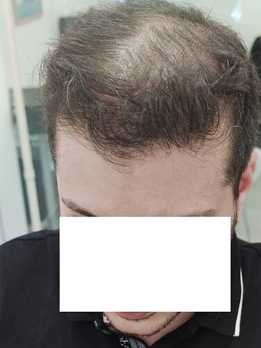 3400 grafts on a Diffuse Thinning case – 1 year after - HDC Hair Clinic photo