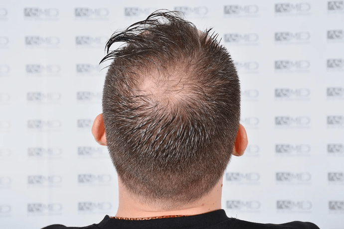 ASMED, Istanbul: 5,071 Manual FUE Grafts 0/12 Months photo