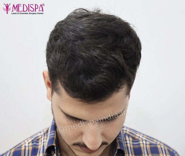 Dr. Suneet Soni - 2500 FUE Grafts, NW- III photo