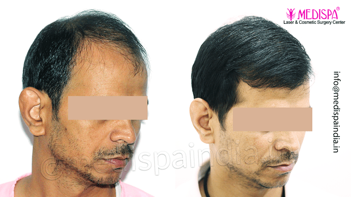 Dr. Suneet Soni - 4533 Grafts, Combine FUT + FUE Technique , NW-IV/V photo