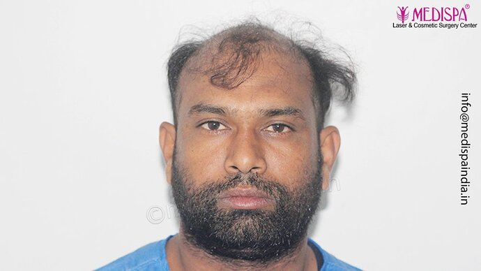 Dr. Suneet Soni - 5498 Grafts, 2 Years Result, Combine FUT + FUE + Beard Technique, NW-VI photo