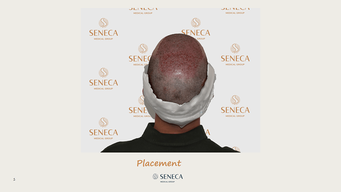 Seneca Medical Group - 2660 grafts with Direct Fue photo