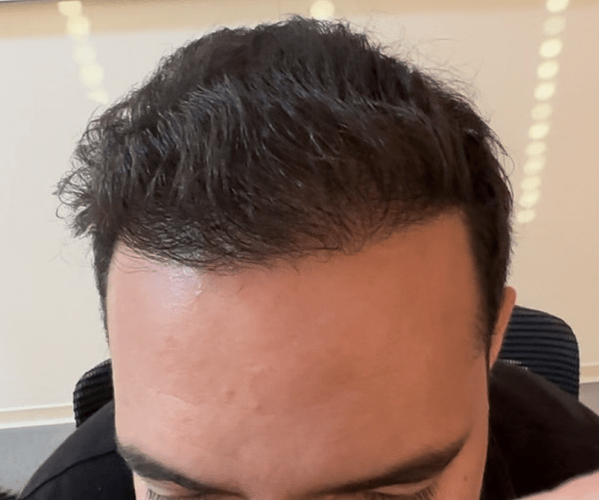 Result of 5000 grafts on NW Class 5 – Giga Session – HDC Hair Clinic – Dr Christina photo