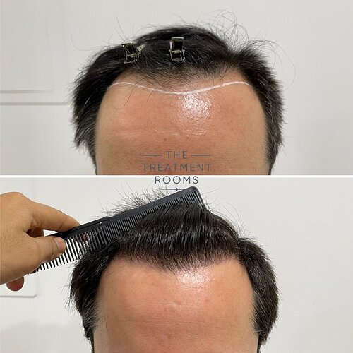 1232 Grafts Hairline Transplant photo