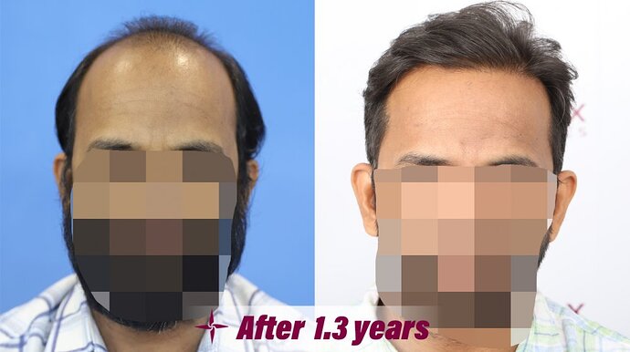 Hair Transplantation Result in 1.3 Years, 5000 Grafts, Grade 6 @Eugenix by Drs Sethi & Bansal photo