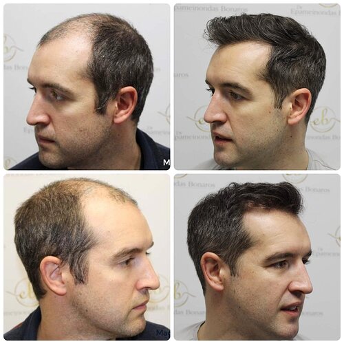 Dr Bonaros, Glasgow, UK / 4033 FUE grafts / 0-12 Months photo