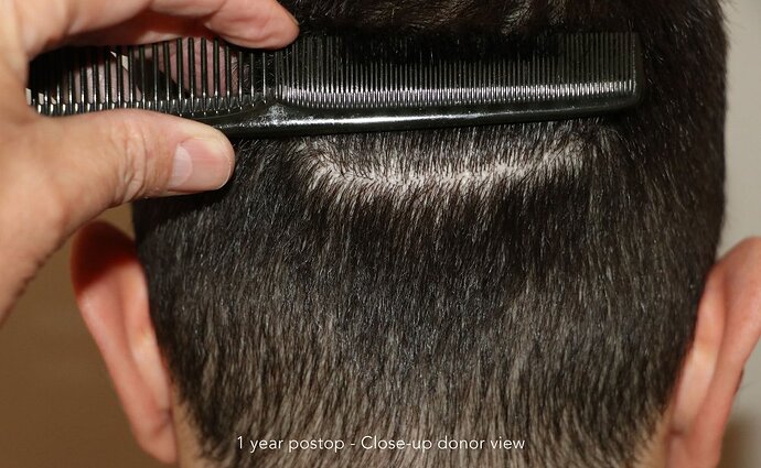 Case performed by Dr. Feriduni – 3744 FU in 1 procedure photo