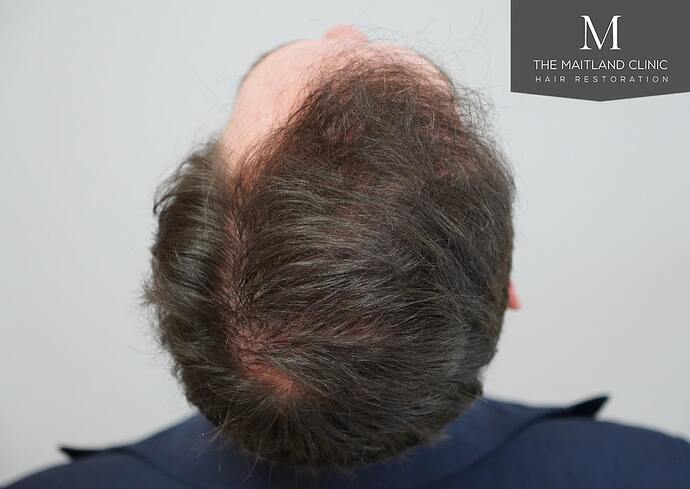 Dr Ball - The Maitland Clinic 1432 Grafts By FUE photo