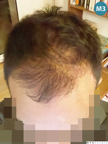 Dr Devroye + Dr Montesanti + Dr Jenard, HTS Clinic / 2018 FUE / Hairline & frontal area photo