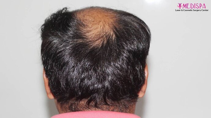 11600 Grafts in 3 FUT Sittings by Dr Suneet Soni photo