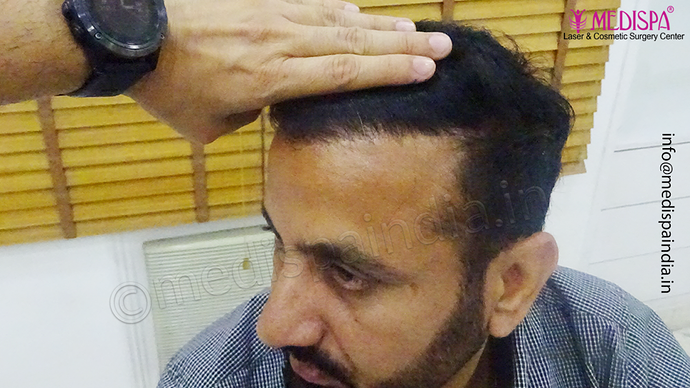 Dr. Suneet Soni - 5334 Grafts, Combine FUT + FUE + BHT (Beard) Technique, NW- V photo