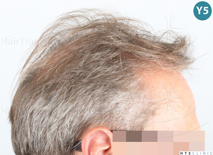 Dr Devroye + Dr Montesanti + Dr Jenard / 7015 grafts (4512 FUT + 2503 FUE) / 2 sessions photo